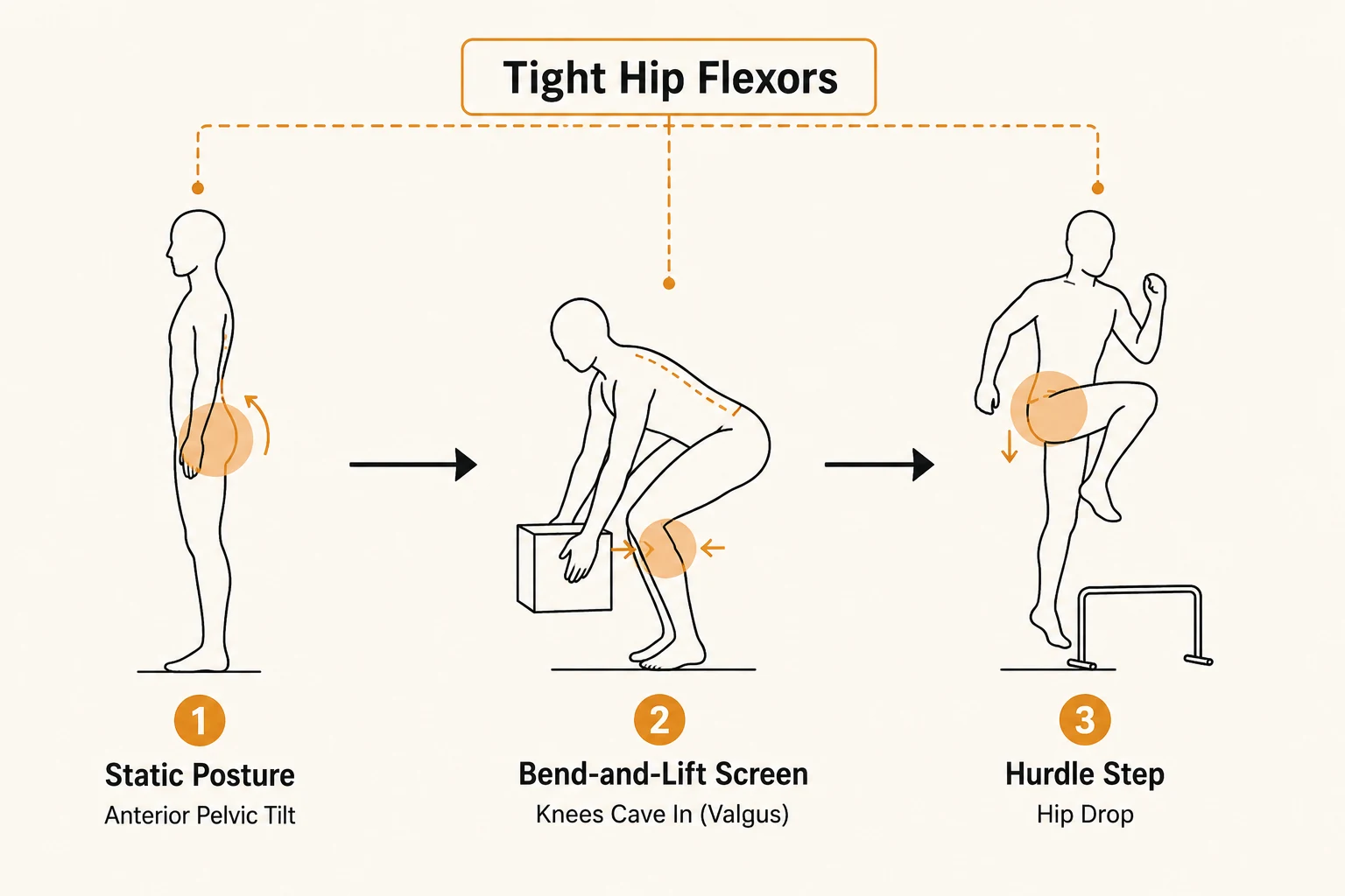 Diagram showing tight hip flexors as one root cause producing three symptoms: anterior pelvic tilt in static posture, knee valgus on the bend-and-lift screen, and hip drop on the hurdle step