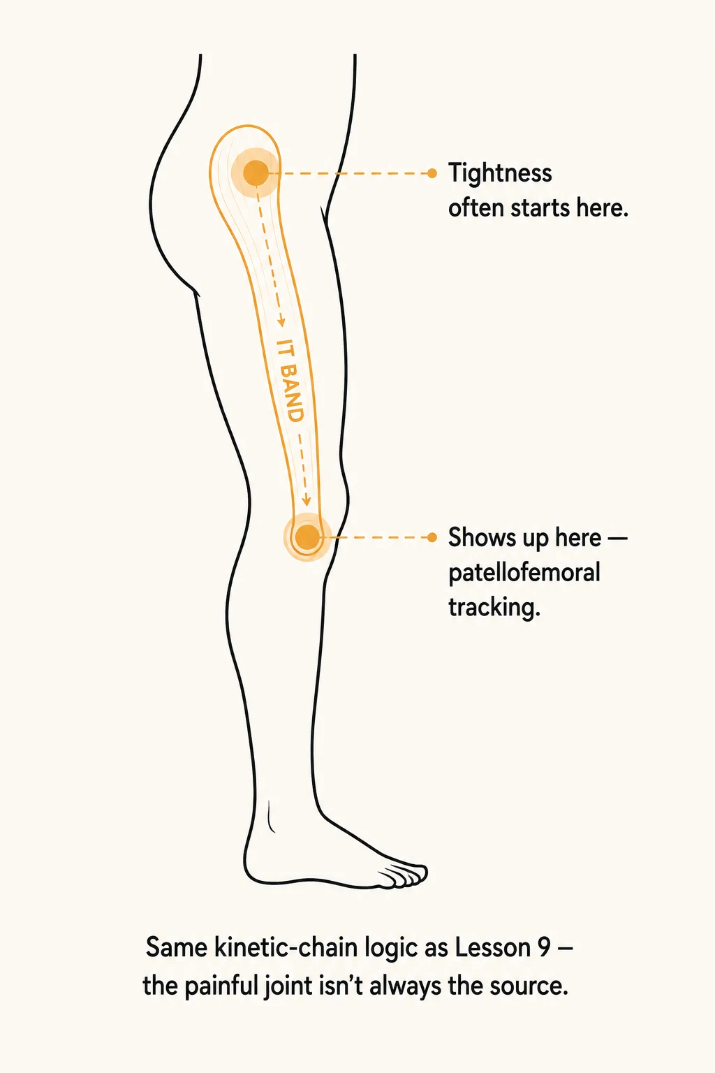 Leg diagram showing the IT band running from the hip to the knee, with tightness often starting at the hip and showing up as patellofemoral tracking issues at the knee