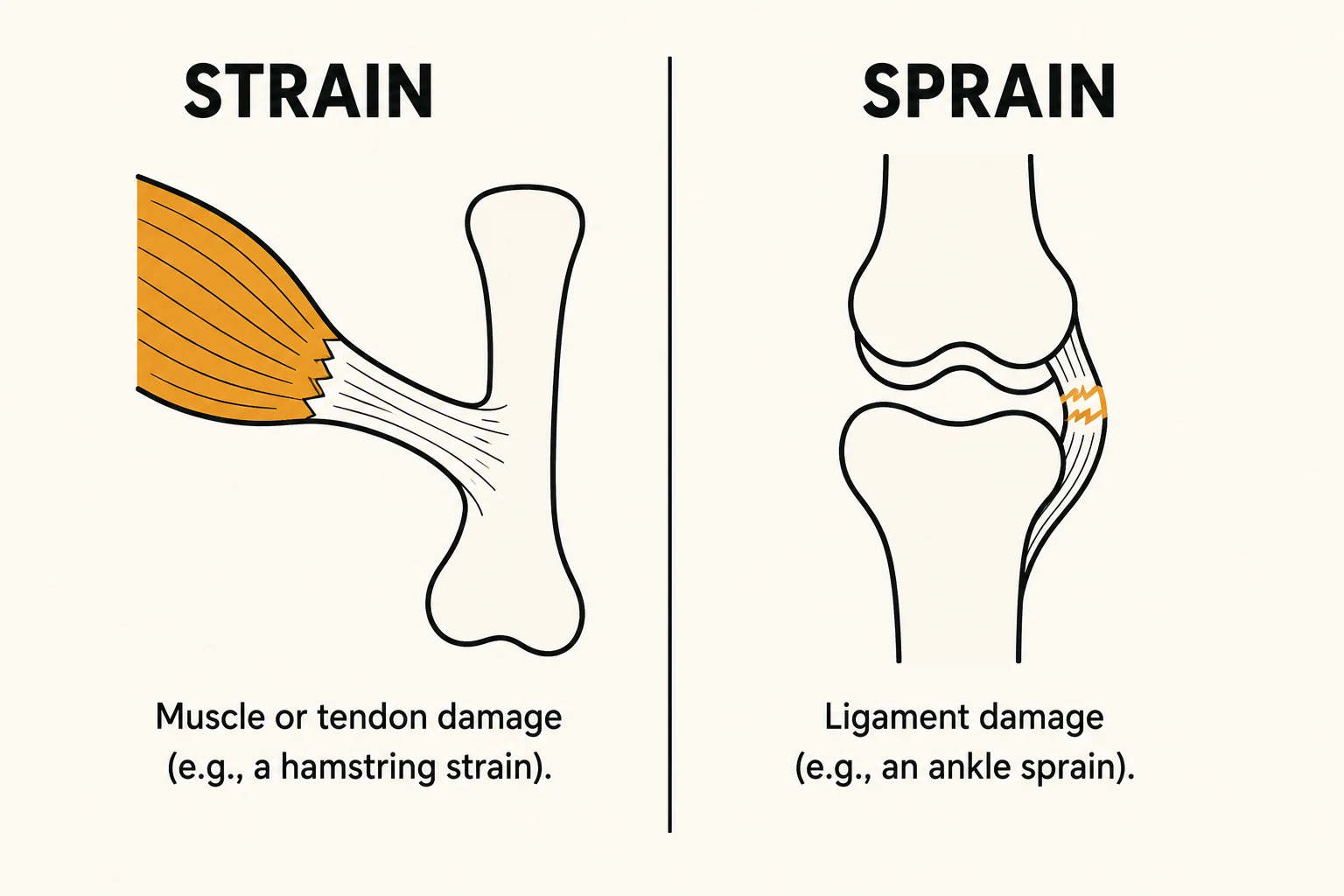 Comparison diagram showing a strain as muscle or tendon damage where muscle meets bone, versus a sprain as ligament damage between two bones at a joint